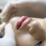 Filler senz’aghi è possibile? Prezzo, recensioni, controindicazioni