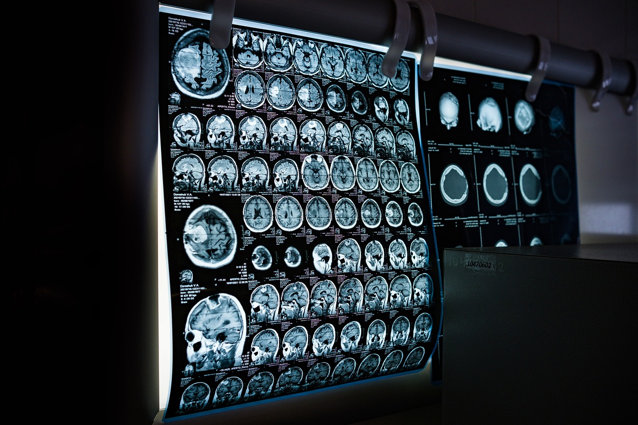 Ictus e ischemia cerebrale: quali sono i sintomi da riconoscere